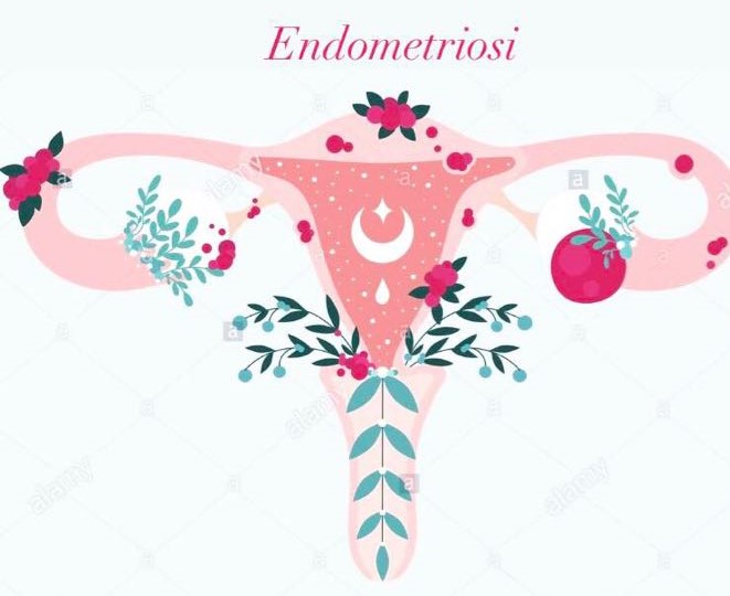 L'endometriosi come impatta la nostra vita?